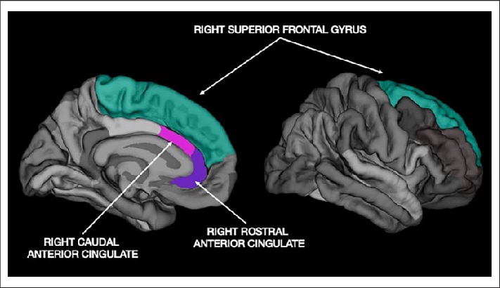 Right Superior Frontal Gyrus